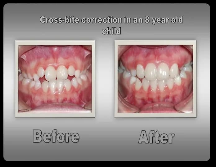 Before treatment: the child's upper and lower teeth in a cross-bite