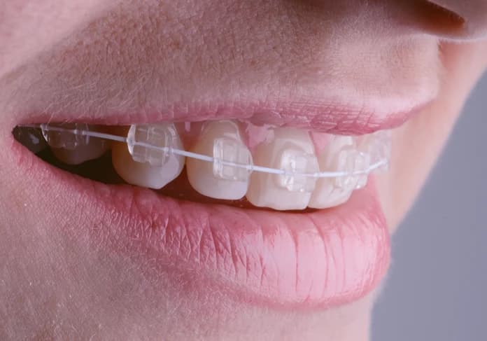 Close-up of a smile with clear ceramic braces on the upper teeth